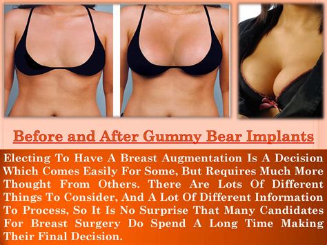 Gummy Bear Implants Before And After Core Plastic Surgery