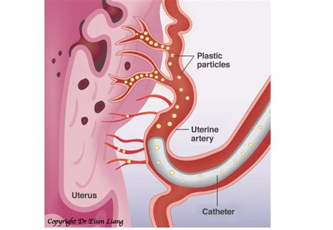 Uterine Artery Embolization For Adenomyosis