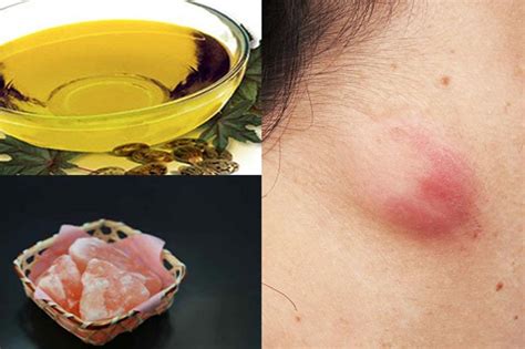 Effective Natural Remedies To Cure Sebaceous Cysts Home Remedies