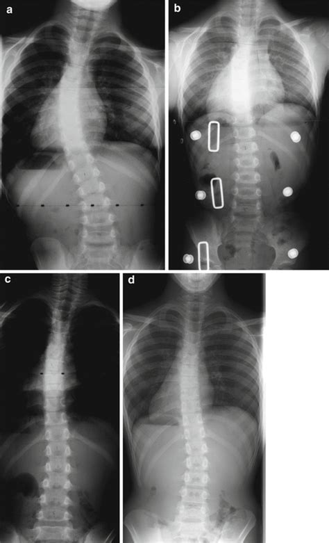 Orthotic Management For Early Onset Scoliosis Neupsy Key