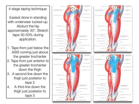 Gluteal Tendinopathy Hip Flexor Kinesiology Taping Hip Workout