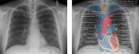 Chest XRay Anatomy Labeled Clinical Radiology Anatomy GrepMed