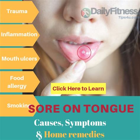 Sore On Tongue Causes Picture Symptoms And Treatment