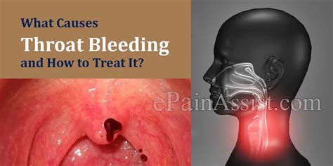 What Can Cause Throat Bleeding And How Is It Treated