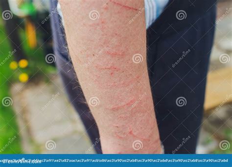 Skin Allergy Diseases Problem Poison Tree Contact Dermatitis Rash By