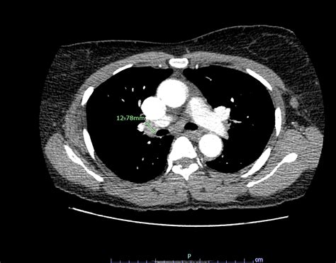 Cureus Delayed Diagnosis In A Rare Case Of Pulmonary Sarcoidosis