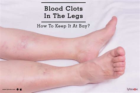Blood Clot In Leg Blood Clot In Legblood Clot In Legblood Clot In Leg