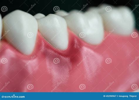 Gingivitis And Dental Model Stock Image Image Of Dentist Abscess