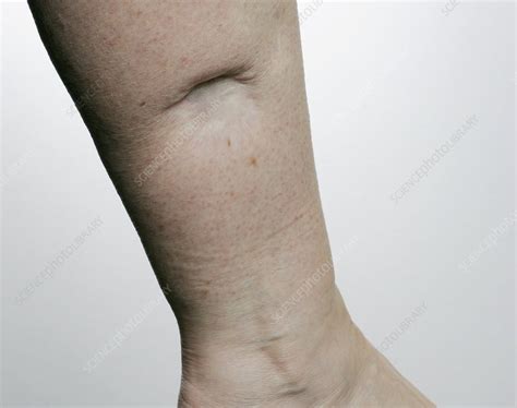 Scar After Skin Cancer Removal Stock Image C0117566 Science