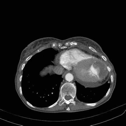 This can occur anywhere in your aorta. Left ventricular aneurysm | Image | Radiopaedia.org