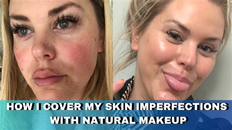 How I Cover My Skin Imperfections With Makeup That Looks Natural Acne