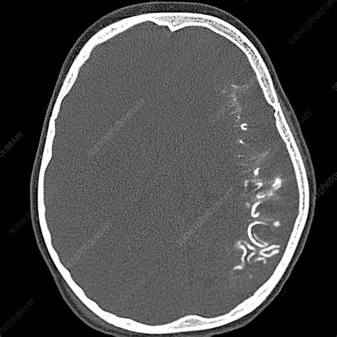 Sturge Weber Syndrome Ct Scan Stock Image C0306518 Science