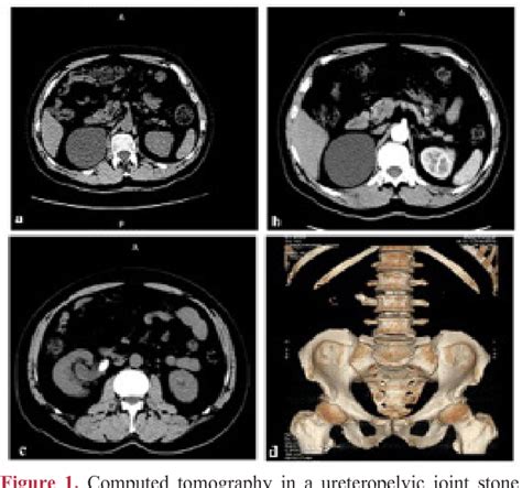 Figure 1 From Simultaneous Treatment Of Renal And Upper Ureteral Stone