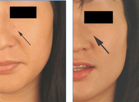 Book your free skin consultation today call 0800 999 3688. Cherry Hemangiomas Before and After Pictures