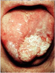 Penurunan asupan makanan dan peningkatan aktivitas tidur otomatis berdampak juga pada suhu tubuhnya. KANSER MULUT / ORAL CANCER??!!!