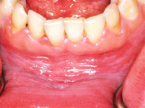 Hard Lump Roof Of Mouth Cancer
