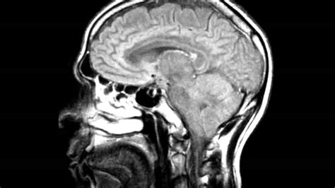 Brain Mri Multiple Sclerosis Youtube