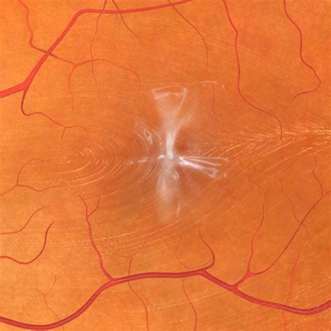 Retina Macular Pucker Montana Retina Consultants