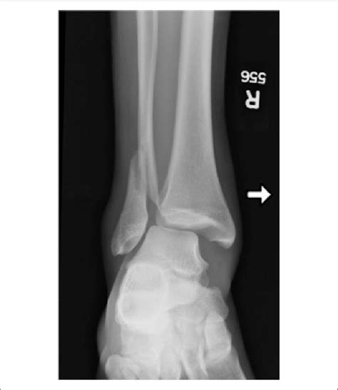 Closed Bimalleolar Equivalent Ankle Fracture With Syndesmotic