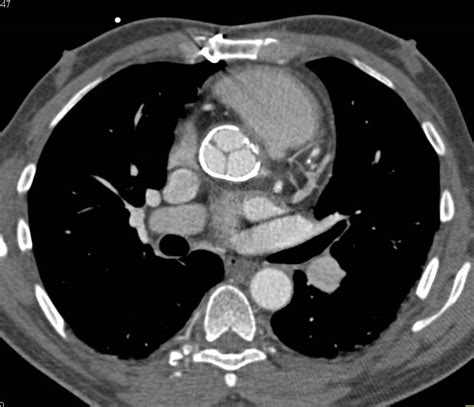 Dilated Ascending Aorta With Thickened Aortic Valve Leaflets Chest