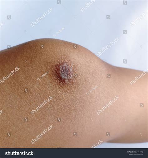 Atopic Eczema On Patient Knee Stock Photo 1861014112 Shutterstock