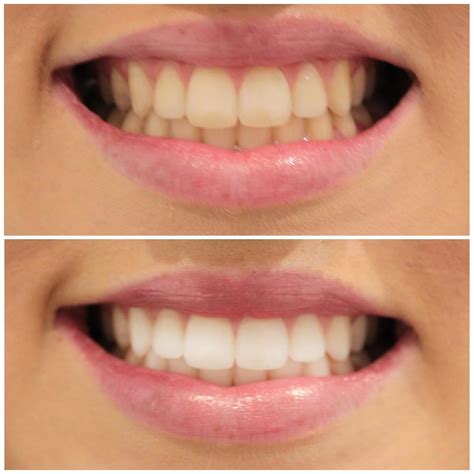 Dental Work Before And After Pictures Smiling Dental