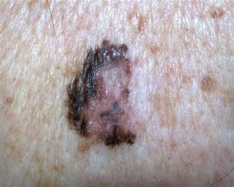 Melanoma Research In New Zealand — Science Learning Hub