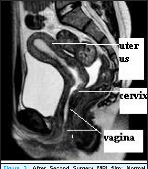 figure 3 from cervical dysgenesis with transverse vaginal septum with imperforate hymen in an 11
