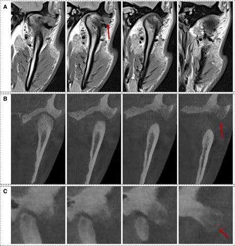 Frontiers Temporal Bone Osteoblastoma Involving Temporomandibular