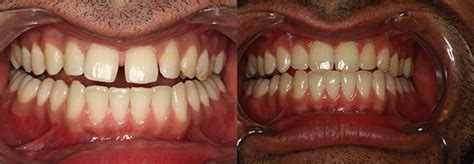 Invisalign For Gaps Between Front Teeth Dr Kamel