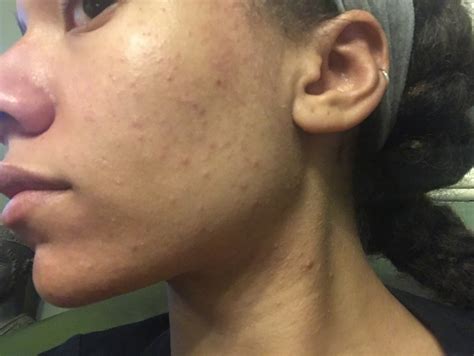 Small Bumps All Over Face Help General Acne Discussion Forum