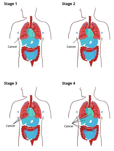 Patients with stage 1 mesothelioma are usually eligible for curative surgery, as their tumors are still contained to the pleura. Mesothelioma Stages | Staging Systems & Categories ...