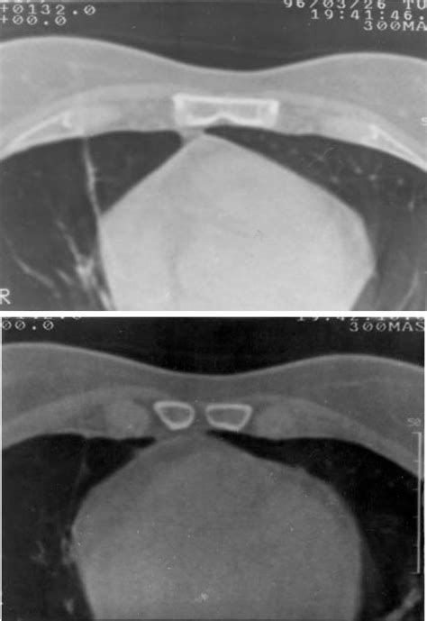 Figure 1 From Anatomic And Hrct Demonstration Of Midline Sternal