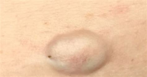 Watch Disgusting Yellow Pus Oozes Out Of Huge Blackhead On Womans