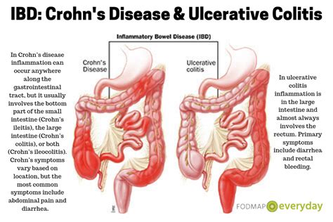 Pin On Inflammatory Bowel Disease Ibd