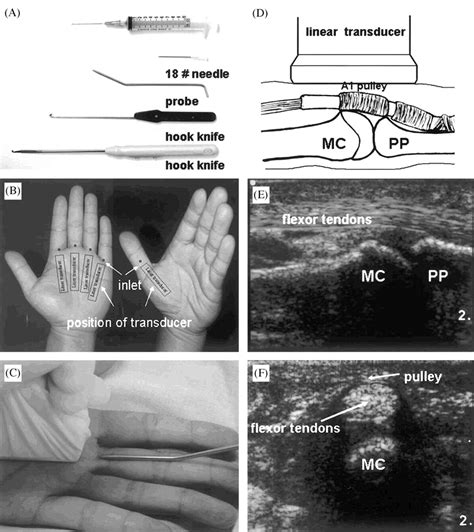 Sonographically Assisted Percutaneous Release Of The A1 Pulley A New