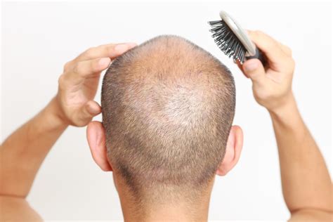 Hair Loss Treatment For Men Early Onset Pattern Thinning