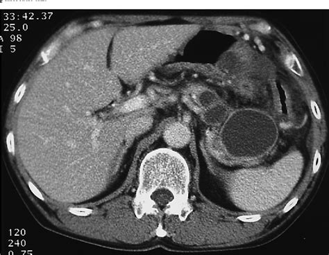 Figure 1 From Pseudocyst In The Pancreatic Tail Associated With Chronic