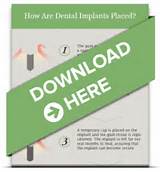 Pictures of Dental Implants Bellevue