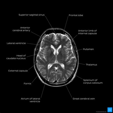 How To Read A Mri Of Brain Brain Anatomy Mri Explained In English The