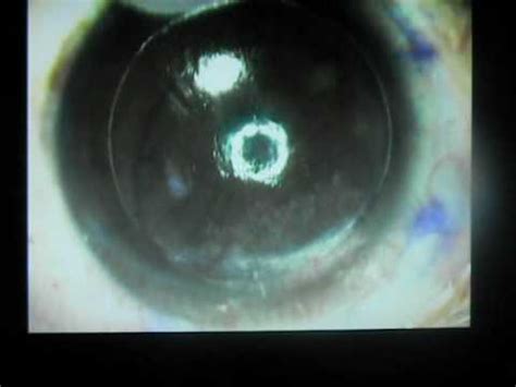 My Intralase Eye Surgery Part 2 Of 2 YouTube