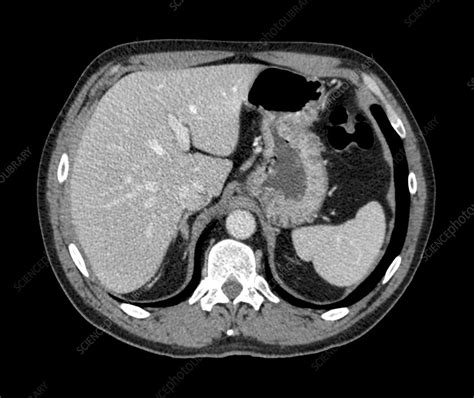 Normal Liver And Spleen Ct Scan Stock Image C0147032 Science