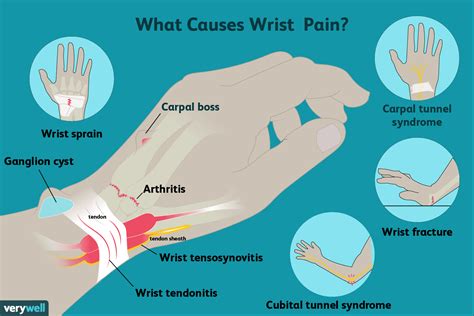 Wrist Pain Causes Symptoms And Treatment Verywell Health Hiswai