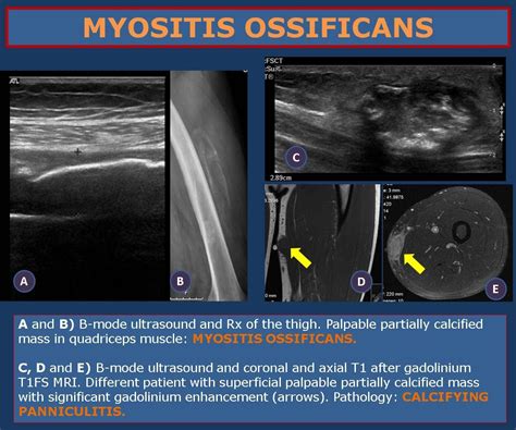 Ecr 2013 C 1867 High Resolution Ultrasound In The Assessment Of