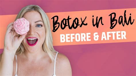 Where To Get Botox In Bali Cocoon Medical Spa Before And After Youtube
