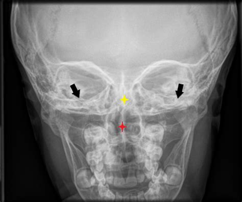 Deviated Septum X Ray