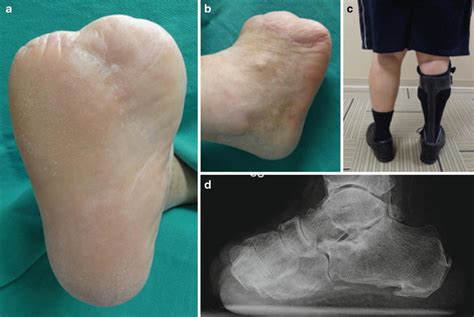 Transmetatarsal And Lisfranc Amputation Musculoskeletal Key