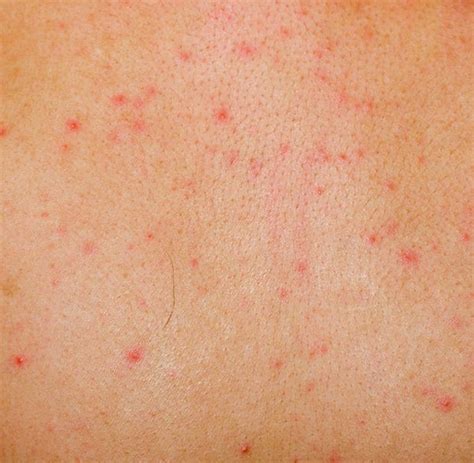 Rash Pinpoint Red Dots On Skin Bangkokpikol