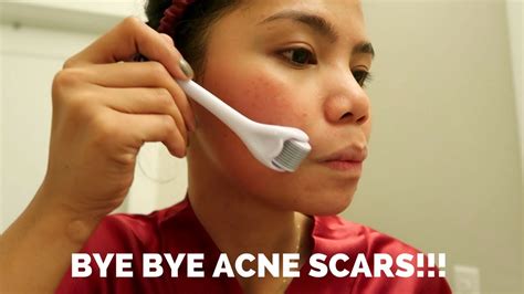 How To Get Rid Of Acne Scars At Home Banish Acne Scars Reviewdemo