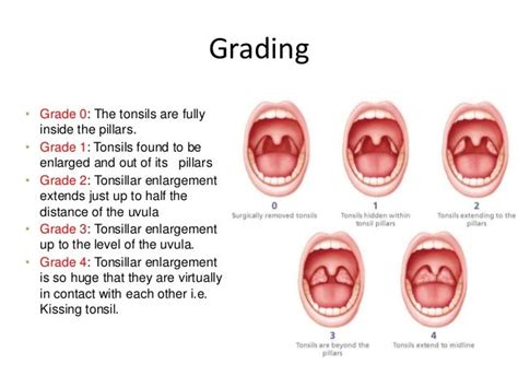 How Do My Tonsils Look Rtonsilstones